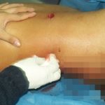 gunshot wounds ER abdomen