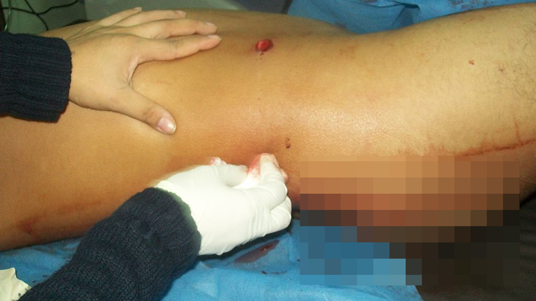 gunshot wounds ER abdomen
